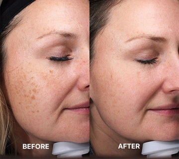 Age spots removed